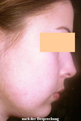 warzenfrei-rechts warzenfrei-rechts