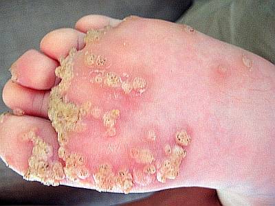 Beginn der Warzenbesprechnung durch Fernbehandlung Beginn der Warzenbesprechnung durch Fernbehandlung