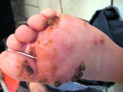 Die Warzen fallen ab. Zustand nach ca. 10 Wochen Fernbehandlung. Die Warzen fallen ab. Zustand nach ca. 10 Wochen Fernbehandlung.