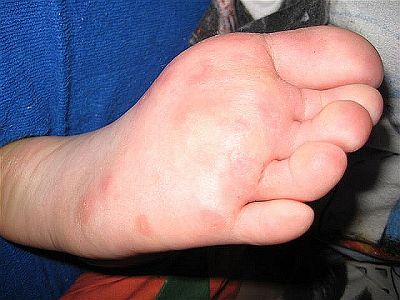 Der Fuß ist warzenfrei. Geheilt durch die Macht der Gedanken. Der Fuß ist warzenfrei. Geheilt durch die Macht der Gedanken.